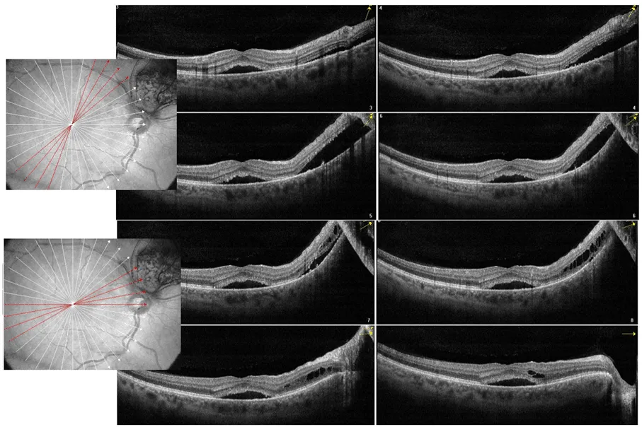 bilde10-choroidal-nevi