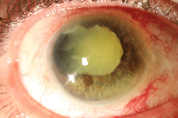 bilde11-choroidal-nevi
