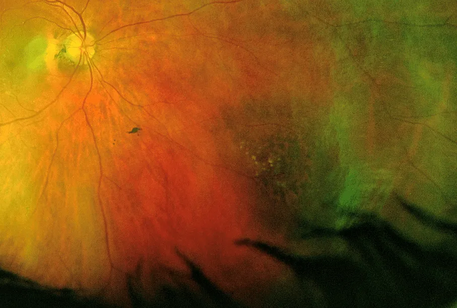 bilde12-choroidal-nevi