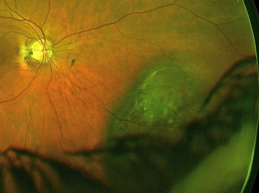 bilde13-choroidal-nevi