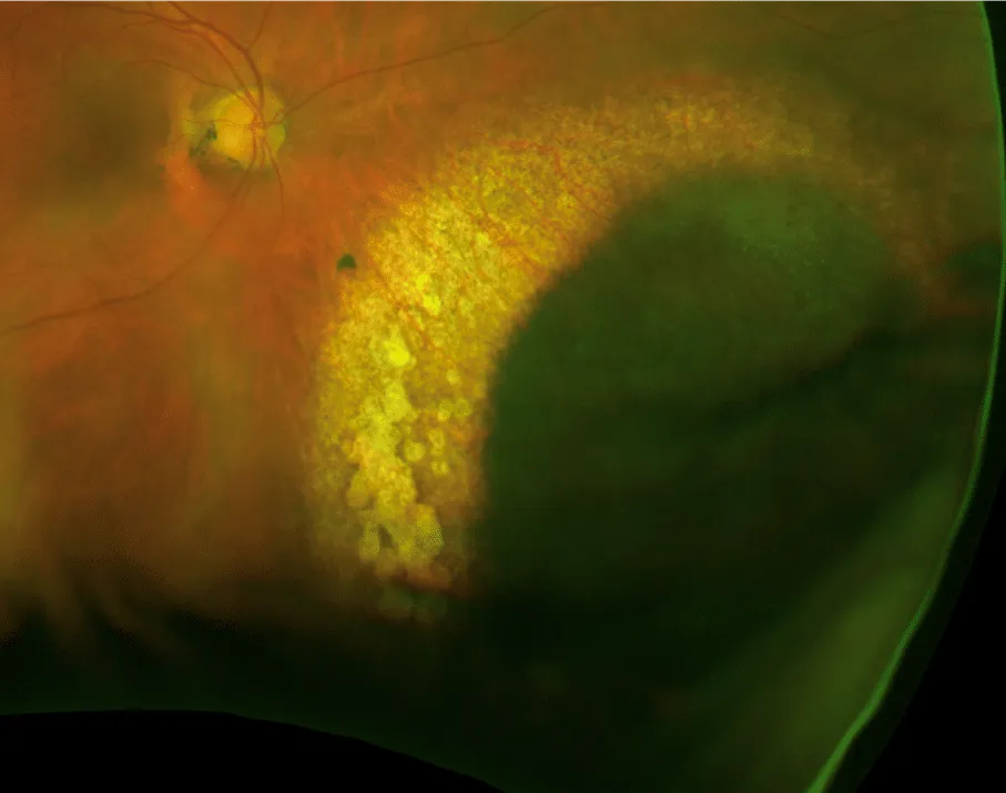 bilde14-choroidal-nevi