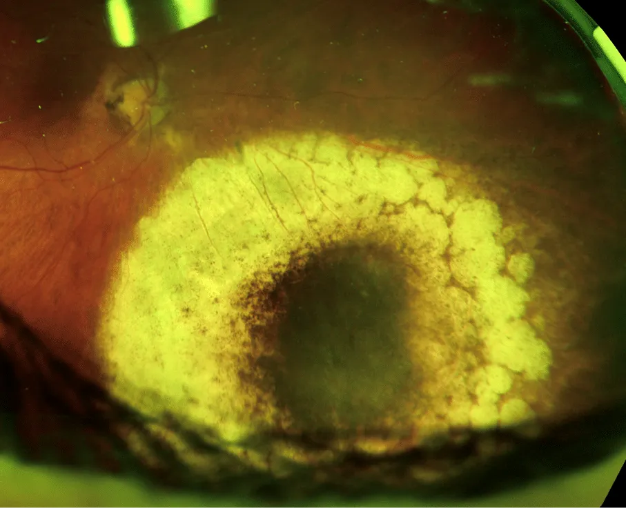 bilde15-choroidal-nevi