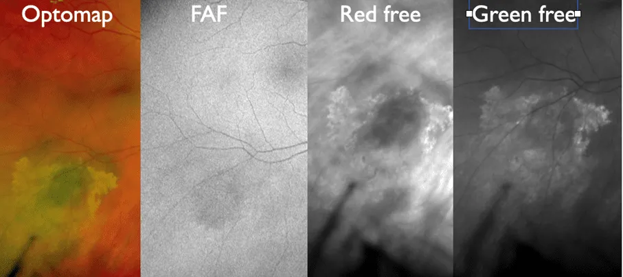 bilde16-choroidal-nevi