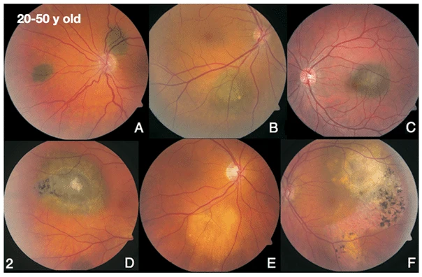 bilde17-choroidal-nevi
