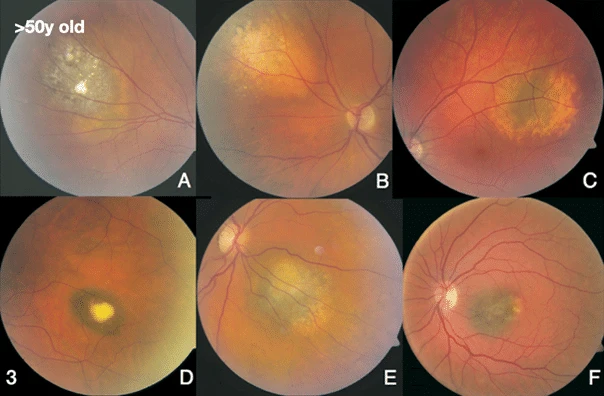 bilde18-choroidal-nevi