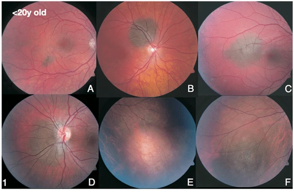 bilde19-choroidal-nevi