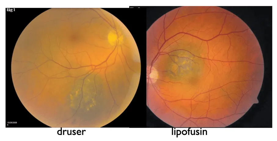 bilde3-choroidal-nevi