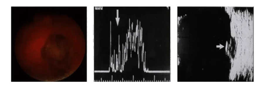 bilde4-choroidal-nevi