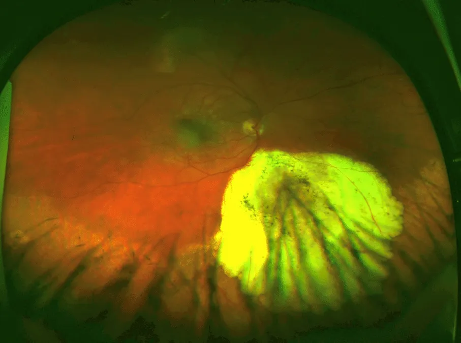 bilde5-choroidal-nevi