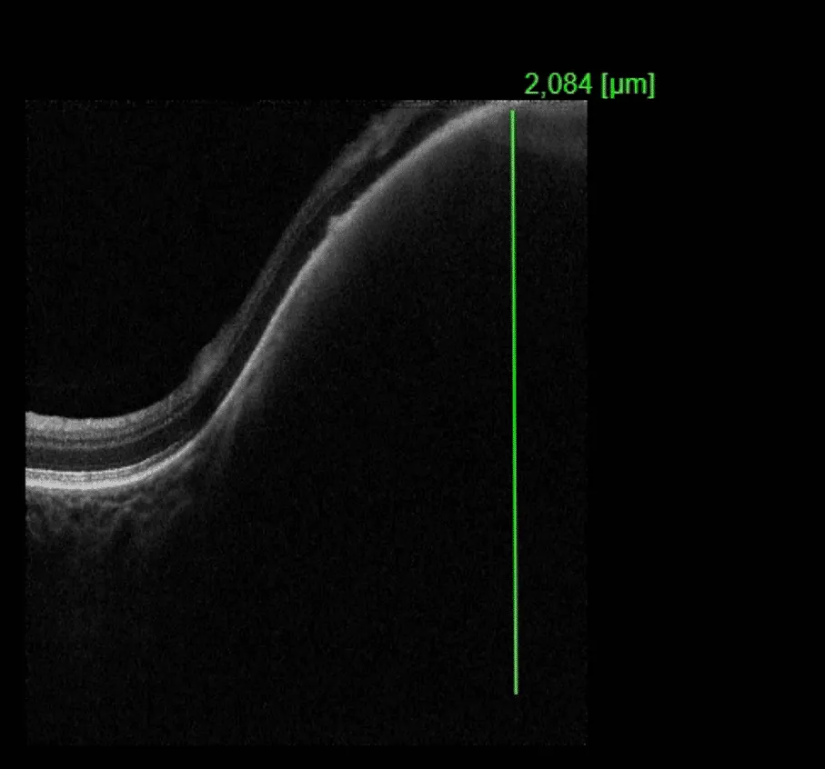 bilde7-choroidal-nevi