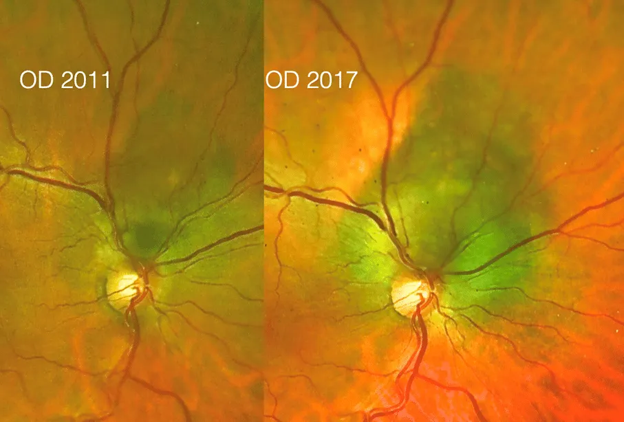 bilde8-choroidal-nevi