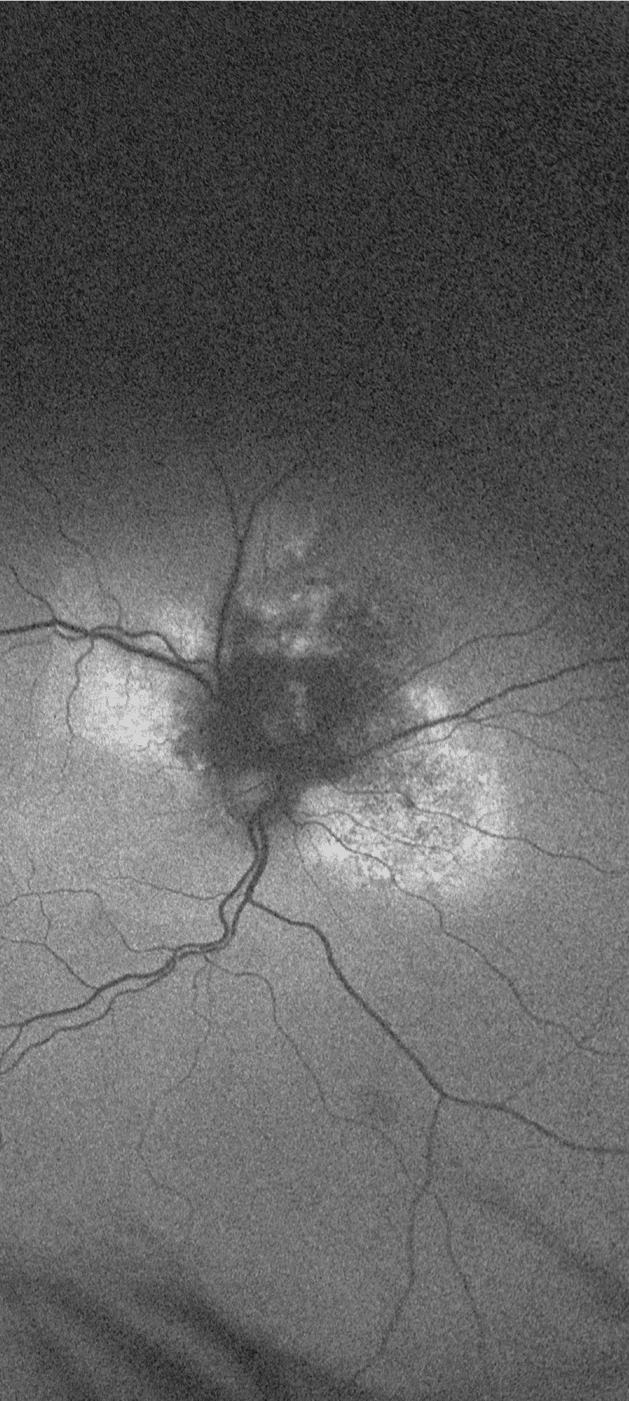 bilde9-choroidal-nevi
