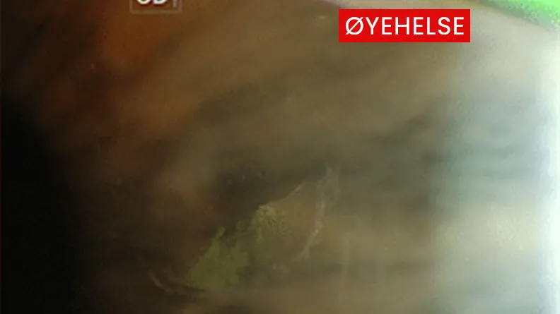 case-residiverende-cornea-erosjon