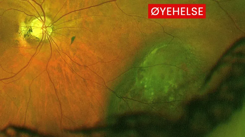 choroidal-nevi