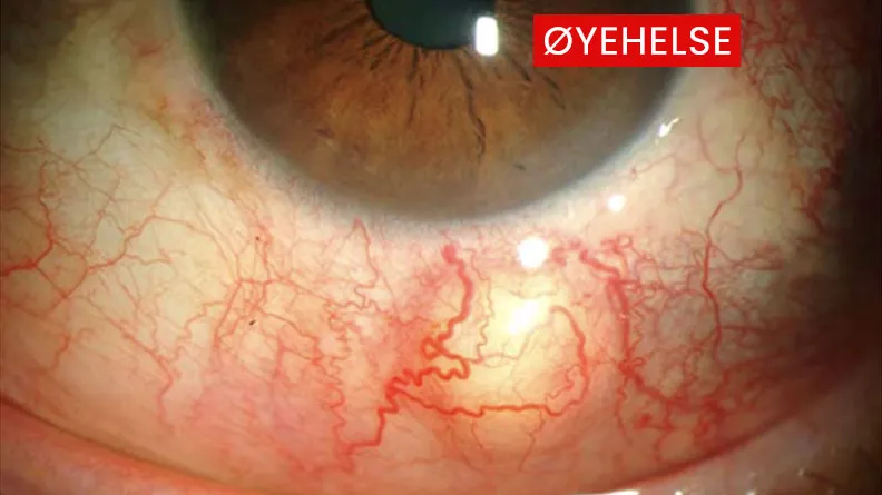 problemer-i-sclera
